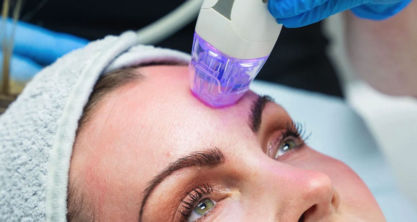 Microneedling en huidverbetering